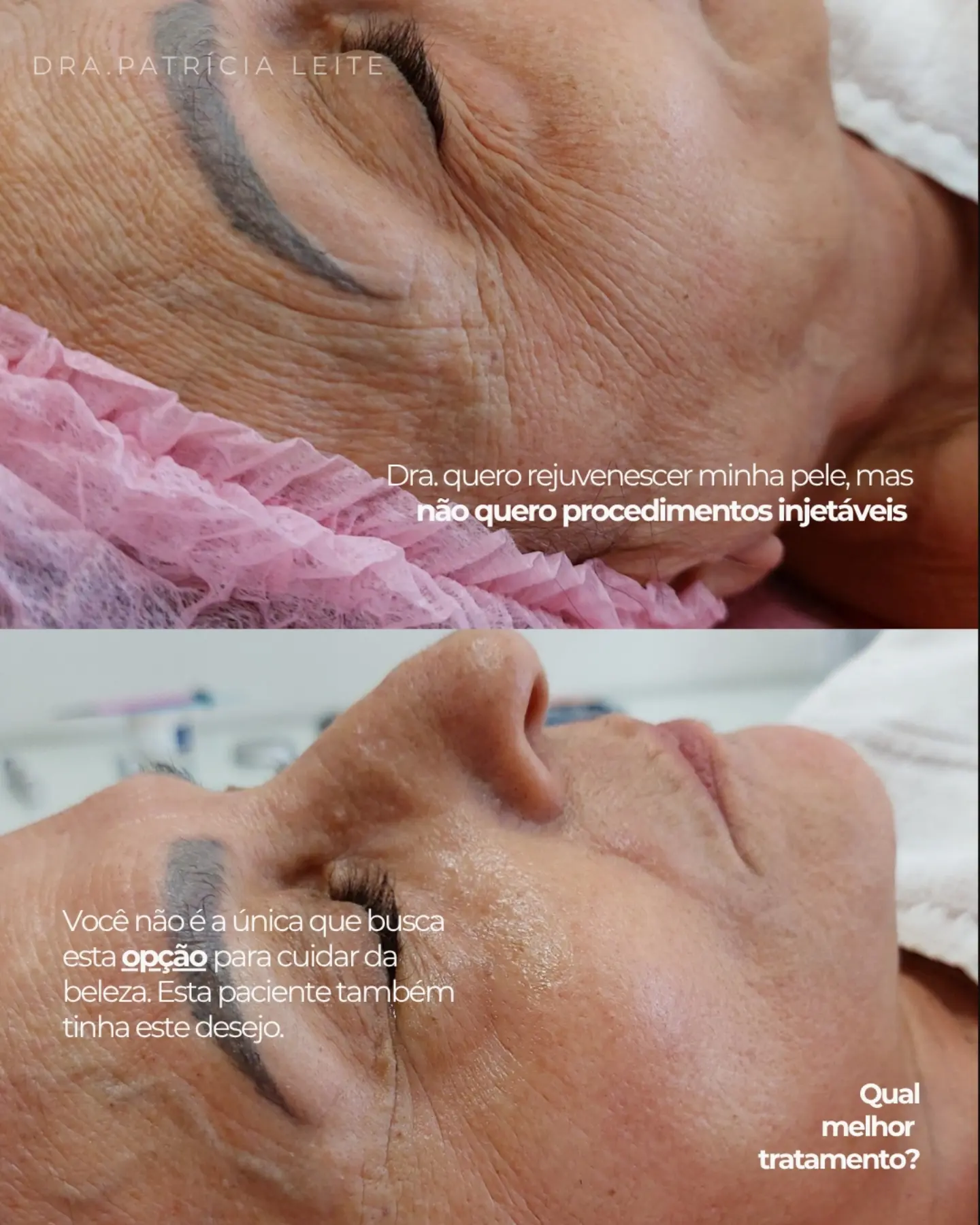 Resultado real de Rejuvenescimento Facial publicado pela Dra. Patrícia