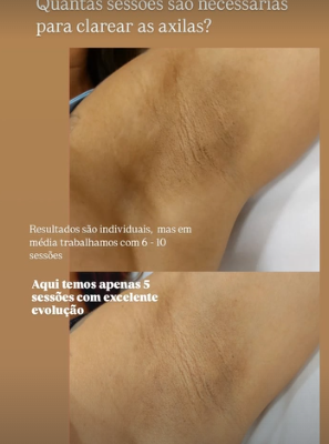 Resultado real de Clareamento Íntimo publicado pela Dra. Patrícia